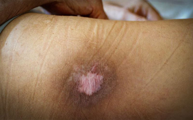 The-Best-and-Fastest-Treatment-for-Bedsores-Complications-of-Bedsores بهترین و سریعترین درمان زخم بستر و درمان زخم بستر عمیق و زخم بستر و درمان آن و آیا زخم بستر درمان دارد و علائم زخم بستر و سریعترین درمان آن - عارضه زخم بستر