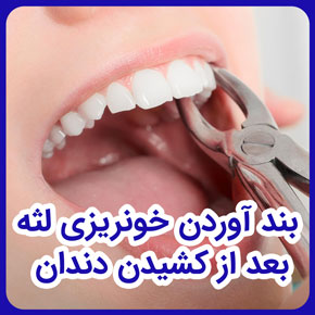 بند آوردن خونریزی لثه بعد از کشیدن دندان و راه بند آوردن خونریزی لثه و دندان و جلوگیری از خونریزی لثه بعد از کشیدن دندان و قطع خونریزی لثه