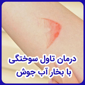 درمان تاول سوختگی با بخار آب جوش و درمان تاول سوختگی دست با بخار اب جوش و درمان سوختگی با بخار آب جوش و پماد تاول سوختگی با بخار آب جوش